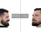 Przed i po: mężczyzna z brodą przed i po zabiegu konturowania brody.