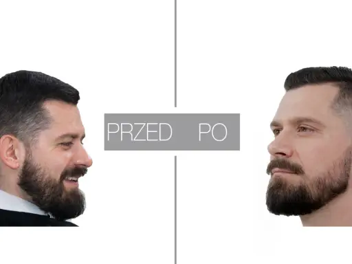 Przed i po: mężczyzna z brodą przed i po zabiegu konturowania brody.