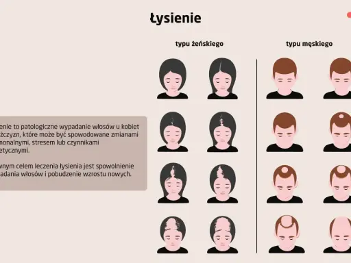 Ilustracja pokazuje różne etapy łysienia androgenowego u kobiet i mężczyzn. Widać stopniową utratę włosów, od przerzedzenia po całkowite wyłysienie.