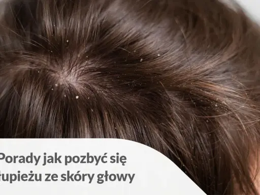 Widoczne białe płatki na ciemnych włosach i skórze głowy. Porady jak pozbyć się łupieżu ze skóry głowy.